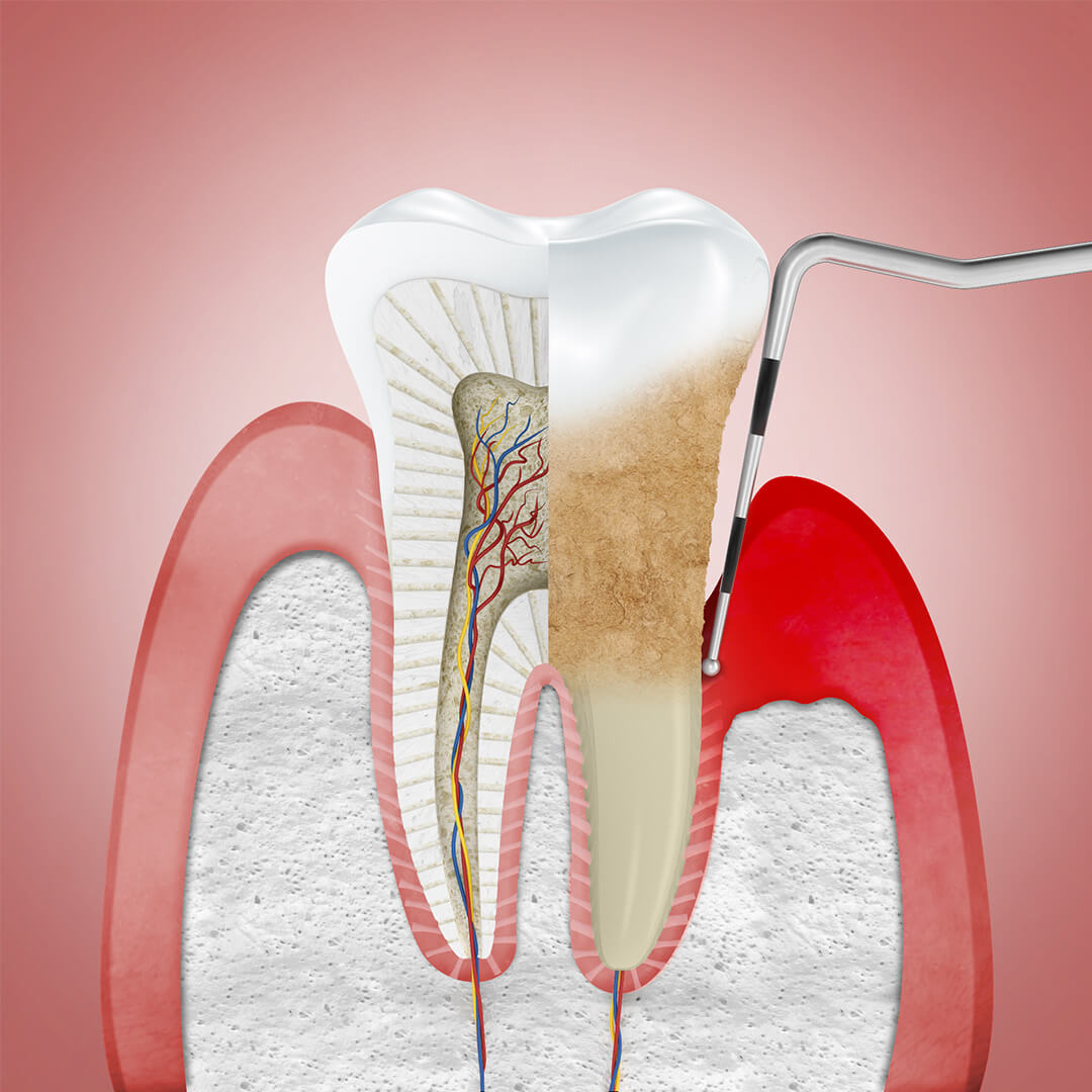 Periodontit Nedir Parodontax
